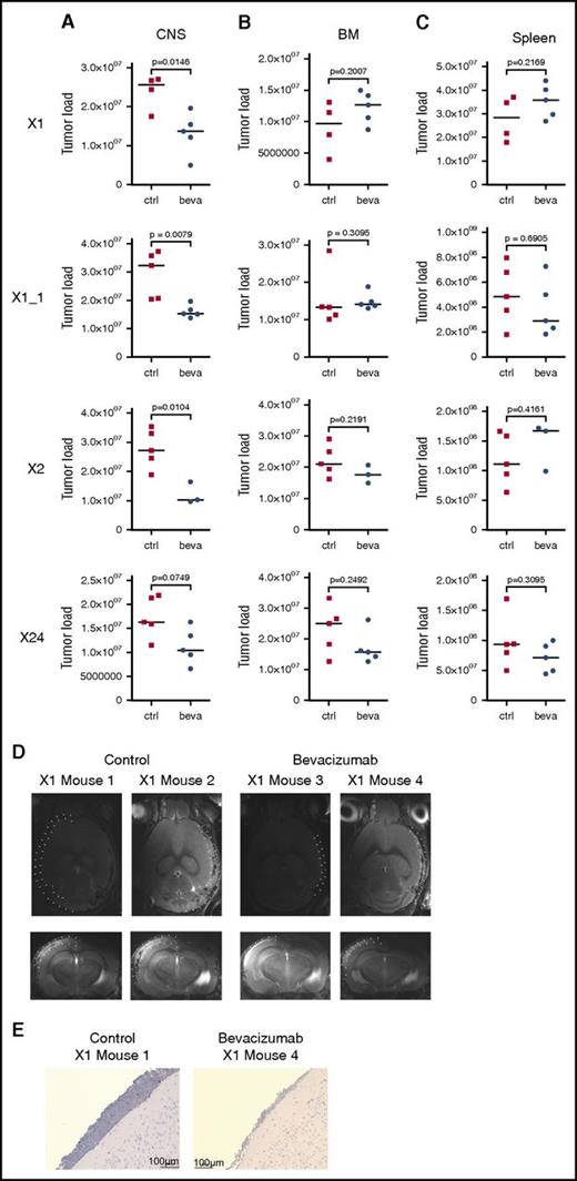 Figure 5. In vivo VEGF capture leads to compartment-specific reduction of leukemia load exclusively in the CNS. Leukemia load in CNS (A), BM (B), and spleen (C) of mice xenografted with 3 CNS+ primografts X1, X1_1 (replicate), X2, and X24 comparing control (ctrl)- and bevacizumab (beva)-treated recipients showing CNS compartment–specific leukemia reduction on VEGF capture (significantly lower CNS tumor load in X1, X1_1, and X2; trend toward lower CNS leukemia load in X24). X1: n = 4 for untreated, n = 5 for beva-treated; X1_1: n = 5 per group; X2: n = 5 for untreated, n = 3 for beva-treated; X24: n = 5 per group (bars indicate median values; significance by 2-tailed Mann-Whitney U test; P values as indicated in graphs). (D) Reduced meningeal ALL infiltration in post-treatment MRI analysis (transversal and coronal sections; meninges highlighted by dotted lines in 1 hemisphere) after bevacizumab compared with ctrl treatment. (E) Reduced meningeal infiltration of huCD19+ BCP ALL cells (immunohistochemistry staining for huCD19, BZ-9000; size as indicated).