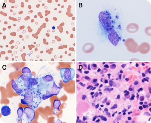 A 41-year-old, HIV-positive Somalian man presented to the HIV clinic with fatigue and abdominal fullness. He denied fever or any other symptoms. The laboratory workup revealed mild pancytopenia and elevated liver function enzymes. Computed tomography identified hepatosplenomegaly and inguinal nodules. The differential diagnosis included infection, lymphoma, and secondary hemophagocytic lymphohistiocystosis (HLH), and a bone marrow (BM) biopsy was performed. The peripheral blood (PB) smear showed rouleaux (panel A, original magnification ×50; Wright stain) and monocytes with intracellular microorganisms bearing prominent nuclei and adjacent rod-shaped kinetoplasts (panel B, original magnification ×100; Wright stain). The BM biopsy and aspirate smear were hypercellular, and also demonstrated histiocytes with similar intracellular microorganisms (panels C-D, original magnification ×100; panel C, Wright stain; panel D, hematoxylin and eosin stain). There was no evidence of hemophagocytosis. Subsequent serology revealed a Leishmania immunoglobulin G level of 15 (positive: 1-15 IU). Confirmatory culture testing performed at the Centers for Disease Control and Prevention was positive for Leishmania donovani. Polymerase chain reaction and DNA sequencing analyses were negative. / This case exhibits BM and PB involvement by leishmaniasis with diagnostic morphology. For the majority of cases, the organisms are often difficult to find, if they are found at all. As shown above, the amastigotes can be found in circulation and within histiocytes, which can lead to reticuloendothelial hyperplasia in the spleen and liver and ultimately result in hepatosplenomegaly. Secondary HLH, which can be associated with leishmaniasis, should also be investigated. However, given the patient’s relative benign clinical presentation, the lack of fever, and absent hemophagocytosis in the BM, it was clinically excluded without further workup. Finally, although molecular methods are more reliable for the detection of organisms, negative results also do not exclude the possibility of the disease, as shown in our case.