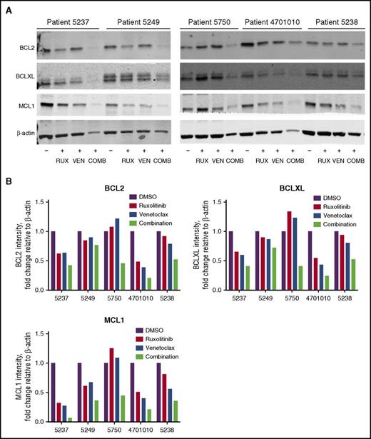 Figure 6. Reduced BCL2, BCLXL, and MCL1 protein in AML patient cells treated with ruxolitinib and venetoclax. (A) Western blot analysis of BCL2, BCLXL, and MCL1 proteins in AML patient cells after treatment with 300 nM ruxolitinib (RUX), 100 nM venetoclax (VEN), or a combination of both drugs (COMB) in 25% HS-5 CM. Protein lysates for patient cells (n = 5) were collected 48 hours after drug treatment and analyzed by immunoblotting, using antibodies to the antigens indicated. Results are shown for patients 5237, 5249, 5750, 4701010, and 5238. (B) Quantification of relative protein levels for BCL2, BCLXL, and MCL1 by analysis of chemiluminescence signals, using Odyssey v2.0 software corrected to the intensities obtained with the β-actin antibody.