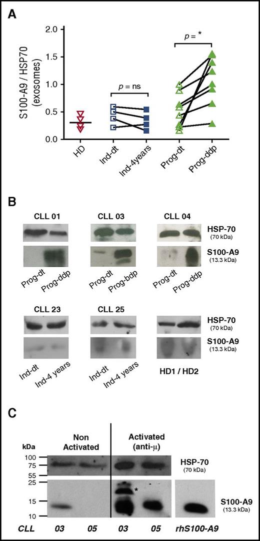 Figure 3. CLL plasma-derived exosomes show increased levels of S100-A9 protein and are released by CLL cells. (A-B) S100-A9 quantification from plasma-derived exosomes between the different subgroups; immunoblot analysis was performed after exosome protein separation. A total of 50 μg of exosome protein from the different samples was transferred onto nitrocellulose and developed with specific anti–S100-A9 monoclonal antibody. HSP-70 protein was visualized as internal charge control. Values of S100-A9 were normalized to those of HSP-70 accordingly. Results showed that S100-A9 protein was significantly higher in the plasma exosomes at the time of disease progression, whereas no or low presence of this protein was found in the exosomes of the Prog-dt subgroup, the indolent group, or the matched HDs. *P < .05. (C) Release of S100-A9+ exosomes by CLL cells; in vitro analysis was performed with CD19+ cells (100 exp10 lymphocytes incubated O.N. with anti-IgM 15 μg/ml). AIM V medium 10 mL was collected and exosomes purified as previously described in Material and Methods. Results showed that CLL cells release exosomes carrying S100-A9 protein to the culture medium after incubation with anti-IgM. *S100-A9 homodimer. Immunoblot analysis was performed as described. ns, not significant.