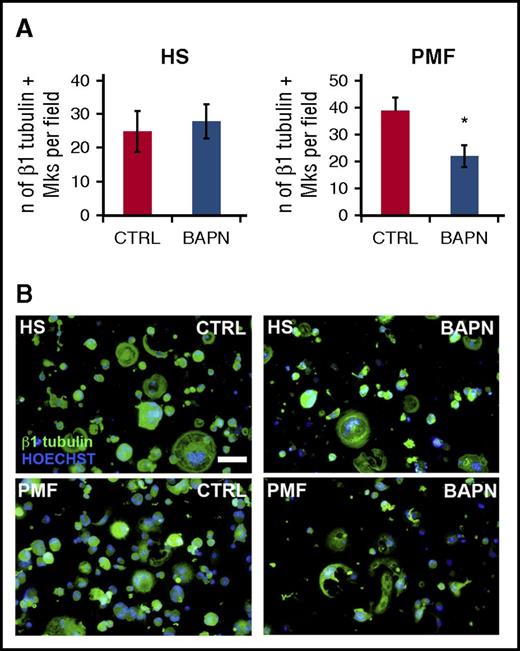 Figure 2. Megakaryocyte adhesion assay. Megakaryocytes were differentiated from CD34+ hematopoietic progenitor cells derived from control HSs or patients with PMF. Because possible oxidation of extracellular residues by secreted LOX would take place during cellular development, it was important to add the LOX inhibitor during this process. At day 2 of differentiation, cells were treated or not with 100 µm of LOX inhibitor BAPN until the end of culturing. BAPN concentration was selected based on consideration of the incubation time, so as to inhibit LOX but avoid effects on cell number (confirmed). At day 13, megakaryocytes were collected and counted, and equal numbers of HS and PMF megakaryocytes were plated on PSCI-coated glass coverslips for 3 hours. Adherent megakaryocytes were fixed and stained with anti-β1 tubulin antibody (green) and counterstained with Hoechst (blue). (A) Adherent HS- and PMF-derived megakaryocytes (Mks) were counted and expressed as number (n) of β1 tubulin+ megakaryocytes per field. Data are expressed as mean ± standard deviation of 5 samples from patients with PMF and 3 HS samples. *P < .05. Ctrl, control. (B) Images of adhering cells; scale bar, 50 µm. See supplemental Methods for additional details on cell culturing, cell isolation, and other procedures and statistics.