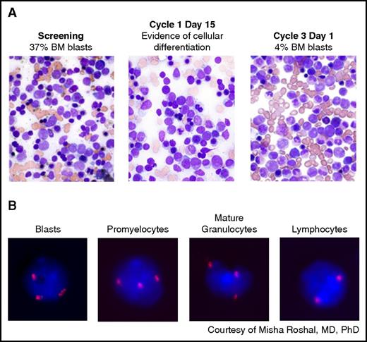 Figure 2. Morphologic evidence of myeloid differentiation during enasidenib treatment. (A) Bone marrow (BM) blasts at screening (left). By cycle 3 day 1 (right), maturing forms including promyelocytes and myelocytes have largely replaced the immature myeloblasts, without initial marrow aplasia or hypoplasia at cycle 1 day 15 (middle). (B) Fluorescence in situ hybridization evidence of myeloid differentiation during enasidenib treatment. At screening, this patient with an IDH2-R140Q mutation had trisomy 8 in the majority of myeloblasts. By cycle 2 day 1, mature forms appeared with persistence of trisomy 8 in promyelocytes and mature granulocytes. In contrast, cells in the lymphoid compartment have a normal complement of chromosome 8.