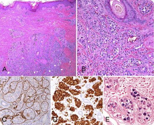 A 51-year-old HIV-negative male from El Salvador presented with neurologic symptoms and computed tomography findings of an acute/subacute cerebral infarction. Physical examination identified indurated and hyperpigmented cutaneous lesions on the legs. A skin biopsy revealed an intravascular infiltrate composed of large atypical lymphoid cells (panel A, original magnification ×20; hematoxylin and eosin stain; panel B, original magnification ×200; hematoxylin and eosin stain), which were delimited by CD31-positive endothelial cells (panel C, original magnification ×200). A cytotoxic T-cell derivation was demonstrated by immunohistochemical stains for CD3 (panel D, original magnification ×200), CD8, TIA-1, and granzyme B. The cells were negative for CD20, CD79a, CD56, and ALK-1. The neoplastic cells were positive for Epstein-Barr virus (EBV) by EBV encoded small RNA in situ hybridization (panel E, original magnification ×400). The cells were negative for LMP-1, indicative of latency I. Polymerase chain reaction identified a clonal T-cell receptor γ gene rearrangement, supporting a T-cell origin. / Intravascular large cell lymphomas (IVLs) are most often of B-cell origin and frequently present with neurological symptoms, including stroke, secondary to accumulation of tumor cells in the intravascular space. IVLs of natural killer (NK)/T-cell type are extremely rare. While it has been suggested that B-cell IVL presenting in the skin has a better prognosis, the prognosis in NK/T-cell cases is dire, with survival measured in weeks to months. NK/T-cell lymphomas are more common in Asian and Hispanic populations, a feature evident in this case.