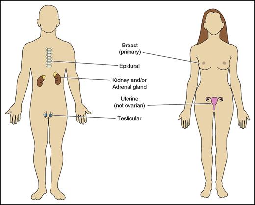 Figure 2. Specific extranodal sites associated with increased risk of CNS relapse.