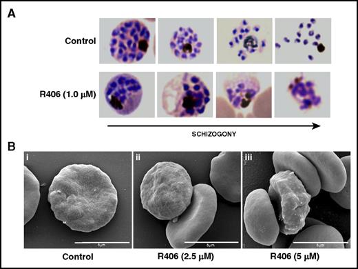Figure 2. Morphological changes and knobs formation in late maturation stages induced by Syk inhibitors. Representative pictures of parasites at 48 hours postinfection in control and in R406-treated cultures selected (A) from Diff-Quik fix stained thin blood films and (B) representative picture of asexual late trophozoite (i) untreated or treated with R406 (ii) 2.5 μΜ and (iii) 5 μΜ obtained by SEM.
