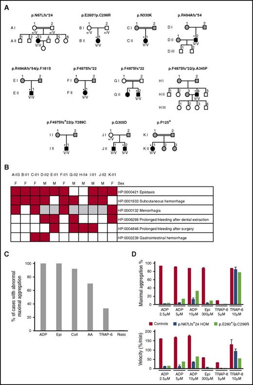 Figure 2. Characteristics of the 11 index cases with likely pathogenic biallelic RASGRP2 variants. (A) Pedigrees of the index cases (*) with likely pathogenic RASGRP2 variants indicating the genotype of the index cases. The black symbols indicate cases with abnormal bleeding and reduced platelet aggregation responses. The white symbols indicate pedigree members without bleeding symptoms, and the gray symbols indicate pedigree members unavailable for evaluation. +/V, heterozygous; V/V, compound heterozygous or homozygous for the variant allele. (B) Annotation of 11 index cases with HPO terms for bleeding symptoms. (C) Summary light transmission aggregation for all 11 index cases. Data are expressed as the proportion of index cases with any reported defect in aggregation responses to ADP, epinephrine (Epi), collagen (Coll), arachidonic acid (AA), TRAP-6, and ristocetin (Risto). (D) Detailed light transmission aggregation response in cases AII-3 and BII-1 in response to the stated agonist concentrations. Data are presented as the maximum aggregation and initial velocity of the aggregation responses.