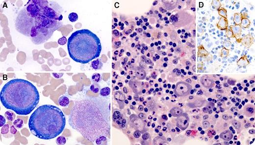 A 66-year-old man developed dizziness and fatigue 2 months after orthotopic heart transplant for ischemic cardiomyopathy. His immunosuppressive regimen included tacrolimus, mycophenolate mofetil, and prednisone. He was found to be severely anemic (hemoglobin, 6.6 g/dL). Clinical studies excluded acute blood loss or hemolysis. Reticulocyte count was 0.2%, and erythropoietin level was 750 mIU/mL (range, 3-19 mIU/mL). A bone marrow aspirate smear revealed large atypical cells with prominent intranuclear inclusions and vacuolated cytoplasm (panels A and B; original magnification ×100, Wright-Giemsa stain), which were also evident on a hematoxylin and eosin stain of the aspirate clot (panel C; original magnification ×40). Megakaryocytes and myeloid precursors were easily identified; however, there was essentially no erythroid maturation. E-cadherin stain confirmed that atypical cells were virally transformed erythroid precursors (panel D; original magnification ×40). Serum parvovirus B19 polymerase chain reaction was positive. Anti-parvoviral immunoglobulin M (IgM) and IgG titers were within normal limits. / Giant virally transformed proerythroblasts and erythroid maturation arrest are classic findings of parvovirus B19–associated pure red cell aplasia. Although most adults acquire lifelong immunity to parvovirus B19 from exposure in childhood, reinfection can occur in the setting of immunocompromise, leading to prolonged severe anemia. In retrospect, our patient had had contact with a granddaughter with high fevers and red cheeks several weeks before his initial presentation. His hemoglobin recovered after supportive transfusions and 5 days of IV immunoglobulin. He remains well 2 years posttransplant.