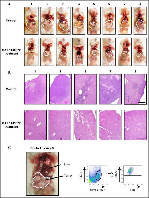 Figure 4. Characteristics of ATL cell–bearing NOG mice. (A) The macroscopic appearances of mice treated with vehicle (control; top panels) or BAY 1143572 (bottom panels). Tumor masses are demarcated by thin white dashed lines. (B) Photomicrographs of hematoxylin and eosin–stained liver sections from mice numbers 1, 5, 6, 7, and 8 treated by vehicle (control; top panels) or BAY 1143572 (bottom panels; scale bar, 500 μm). (C) The macroscopic appearance of ATL cell–bearing control mouse 6; i.p. tumor masses are demarcated by thin white dashed lines (left panel). Human CD45+ cells within masses were positive for CD4 and CD25, being consistent with ATL cells as determined by flow cytometry (the 2 right panels). SSC-H, side scatter height.