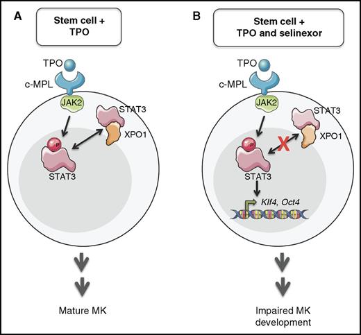 Model of XPO1, STAT3, and selinexor interactions in normal and impaired thrombopoiesis based on the findings of Machlus et al. Binding of TPO by c-Mpl on MK progenitors (A) triggers multiple events, including activation of the JAK2/STAT3 pathway. The accumulation of pSTAT3 in the nucleus is normally limited by XPO1-mediated export of STAT3 to the cytoplasm, but XPO1 inhibition by selinexor (B) allows accumulation of nuclear STAT3, which can be phosphorylated (P) to its active form. These events lead to upregulation of Klf4 and downstream genes, including Oct4, which promotes an undifferentiated state countering the prodifferentiation TPO signal. Thus, selinexor treatment impairs TPO-dependent MK maturation and promotes the onset of thrombocytopenia. See Figure 6G in the article by Machlus et al that begins on page 1132.
