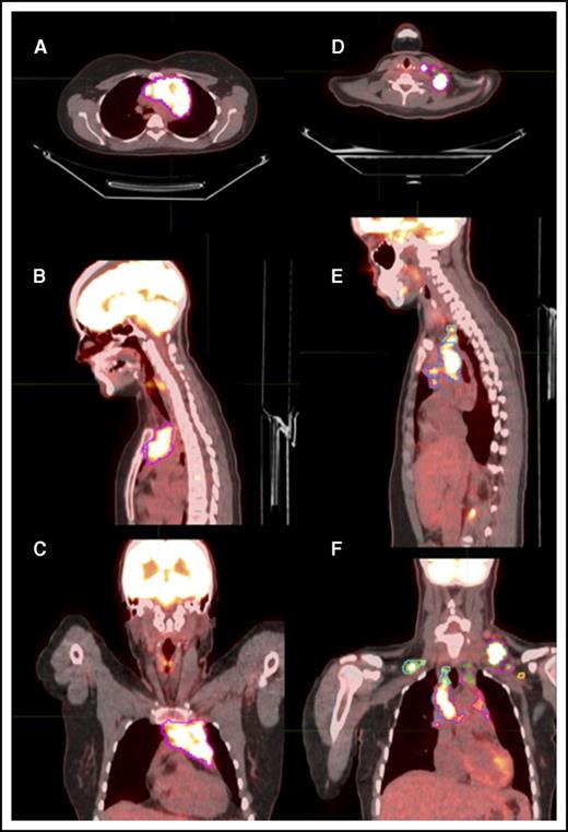 Figure 1. Representative delineation of MTV based on both the MTVst and MTVt contouring methods. Axial, sagittal, and coronal sections might not show the same node but rather different regions of disease in each anatomical section. (A-C) Axial, sagittal, and coronal scans of mediastinal disease contoured based on MTVst (magenta) and MTVt (blue) methods. (D) Axial view of left cervical neck disease contoured based on MTVst (magenta) and MTVt (green) methods. (E) Sagittal view of left cervical neck disease contoured based on MTVst (magenta) and MTVt (green) methods and mediastinal disease contoured based on MTVst (blue) and MTVt (pink) methods. (F) Coronal view of left cervical neck disease contoured based on MTVst (magenta) and MTVt (green) methods, mediastinal disease contoured based on MTVst (blue) and MTVt (pink) methods, left axillary disease contoured based on MTVst (yellow) and MTVt (brown) methods, and right cervical neck disease contoured based on MTVst (light blue) and MTVt (light green) methods.
