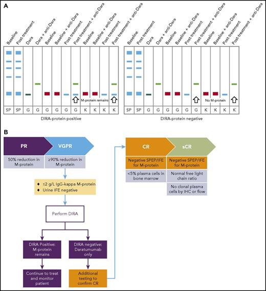 Figure 4. Daratumumab interferes with the evaluation of response. (A) The mean trough and peak serum daratumumab concentrations at the end of weekly 16 mg/kg dosing are 573 μg/mL and 915 μg/mL, respectively.33,34 These concentrations decrease slightly when patients enter the less-intense dose periods.33,34 These concentrations are greater than the sensitivity for most SPEP and serum IFE assays, which explains that daratumumab and also other therapeutic antibodies can be detected as a monoclonal band in SPEP and IFE when patients are assessed for response. Comigration of daratumumab (IgG-κ) with an IgG-κ M-protein during SPEP and IFE can mask clearance of a patient’s endogenous M protein in response to treatment. The daratumumab-specific IFE reflex assay (DIRA) uses a highly specific mouse anti-daratumumab antibody that binds daratumumab and shifts its migration away from endogenous M protein on IFE gels. Of note, because the anti-daratumumab antibody is of mouse origin, it is not precipitated with antibodies directed at human immunoglobulins.82 The mouse anti-daratumumab antibody is therefore not detected as an additional band in the DIRA. (B) If an IgG-κ band remains that is not shifted completely by the DIRA, the patient is considered to have residual M protein, and disease monitoring should continue. Patients with a single IgG-κ band that is shifted completely by the DIRA are considered to have no remaining serum M protein and may have reached CR/sCR, and therefore are candidates for additional IMWG-required confirmatory testing (BM evaluation, free light-chain assay). Dara, daratumumab; G, IgG antisera; IHC, immunohistochemistry; κ, κ antisera; sCR, stringent CR; SP, total serum protein fix; VGPR, very-good partial response.