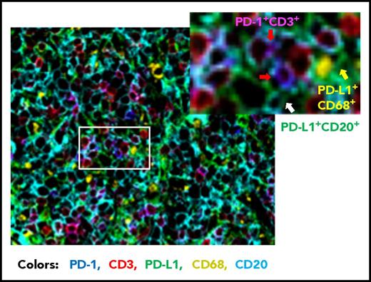 Figure 2. Representative overlaid image of PD-1 and PD-L1 expression in a de novo DLBCL sample by fluorescent multiplex immunohistochemistry. Fluorescent colors show the following: blue for PD-1+, green for PD-L1+, red for CD3+, yellow for CD68+, and cyan for CD20+. Examples of PD-1+ T cells are indicated by the red arrows (co-localization of PD-1+ and CD3+ signals are shown in magenta), a PD-L1+ CD68+ cell (macrophage/dendritic cell) is indicated by the yellow arrow, and a PD-L1+ lymphoma cell (CD20+) is indicated by the white arrow. Original magnification ×20.