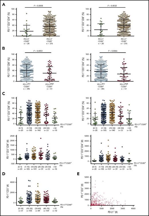 Figure 4. Correlation between PD-1 and PD-L1 expression in DLBCL. (A) At a low cutoff for PD-L1 positivity on CD20+ lymphoma cells, the PD-L1+ group (95% of the cohort) had a significantly higher mean level of PD-1 expression than the PD-L1– group. (B) At a 30% cutoff for PD-L1high on CD20+ lymphoma cells (according to Kiyasu et al57), the PD-L1high group (12.9% of the cohort) had a significantly lower mean level of PD-1 expression than the PD-L1low group. (C) PD-L1 levels on lymphoma cells were further stratified and correlated to PD-1+ levels (%) and absolute PD-1+ T cell numbers in the tumor microenvironment. (D) PD-L1 levels (%) on CD68+ cells were stratified and correlated to absolute PD-1+ T-cell numbers in the same tissues. (E) Dot plot for total PD-L1+ and PD-1+ cell counts in DLBCL tissues. Each dot represents the data for 1 patient.