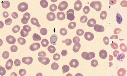 A 12-year-old female presented with fatigue and weight loss. She appeared pale and had gray streaks in her hair. She had a history of chronic anemia, and some family members also had anemia. Laboratory tests showed macrocytic anemia (hemoglobin 5.2 g/dL, MCV 107.3 fL) and thrombocytopenia (platelet count 129 × 109/L), increased blood homocysteine (111.6 μmol/L, reference range 4.7-10.3), and decreased vitamin B12 (111 pg/mL, reference range 260-935). Wright-stained peripheral blood smear showed macrocytosis, anisopoikilocytosis, a few polychromatophilic red blood cells with rare purple Cabot rings (panel A, arrow), and coarse basophilic stripling (panels B and C). Workup for vitamin B12 deficiency identified a homozygous pathogenic variant in the AMN gene, which is consistent with Imerslund-Gräsbeck syndrome (IGS), a rare autosomal recessive disorder caused by a defect in the receptor of vitamin B12–intrinsic factor complex in terminal ileum. This receptor is composed of 2 proteins, amnionless (AMN) and cubilin (CUBN). Mutations of either the AMN or CUBN gene can cause IGS. / Cabot rings are thin, threadlike ring- or “figure eight”–shaped red blood cell inclusions, likely remnants from mitotic spindles. They are rarely seen in peripheral blood, and their presence indicates a defect in erythrocyte production, especially in pernicious anemia and lead poisoning.