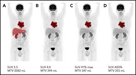 Metabolic tumor volume measured with different cutoff values. (A) Example of a clearly failed MTV delineation when using the SUV 2.5 delineation method for this specific patient study. Even visually similar and accurate tumor volumes (B-D) are quantitatively substantially different.