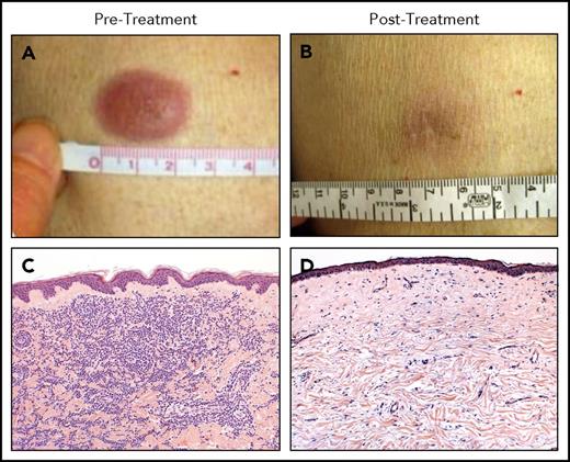 Figure 3. Clinical and histopathologic responses to ipilimumab therapy in a representative patient with leukemia cutis. Pretreatment (A-C) and posttreatment response (B-D) in a patient with leukemia cutis and corresponding histologic response. (C,D) Hematoxylin and eosin staining. Adapted from Davids et al68 with permission.