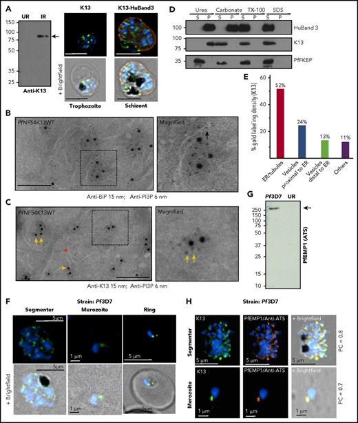 Figure 2. Stage-specific expression and localization of K13 in relation to ER-PI3P, PfBiP, and PfEMP1. (A) Custom antibodies to K13 (supplemental Methods) detect an 83-kDa band in Pf3D7-infected red cells (IRs) but not uninfected red cells (URs) in Western blots (molecular weights in kDa) and localize K13 (green) by IFA in trophozoite and schizont stages (counterstained for host band 3, red), as imaged with a 100×, NA-1.4 objective on an Olympus IX inverted fluorescence microscope using DeltaVision Deconvolution microscopy.25 (B-C) Cryo-IEM of PfNF54K13WT dually probed for PI3P (6 nm gold) and ER marker BiP (15 nm gold) (B) or K13 (15 nm gold) (C). Black arrow indicates PI3P in lumen of ER tubule; yellow arrows indicate cytoplasmic PI3P; double yellow arrows indicate PI3P vesicular clusters outside of ER tubules on the cytoplasmic face; red arrow indicates low level of PI3P vesicles devoid of K13. Scale bar, 100 nm. (D) Membrane association of K13. Lysates of Pf3D7 were treated as indicated, separated by centrifugation (15 000 g for 30 min) into membrane pellet and soluble supernatant fractions and probed in Western blots for parasite and host (human) markers. Adding 6 M urea (a strong chaotropic agent) for 30 min at 23°C to parasite cell lysates failed to release K13 from the pellet (of parasite cell lysates), although the cytosolic parasite protein PfFKBP was quantitatively detected in the soluble fraction, suggesting that K13 was membrane associated. Sodium carbonate 100 mM, pH 11.5, for 30 min on ice released K13 from the pellet, suggesting that it was peripherally (but not integrally) associated with membranes (and consistently, K13 was also released by 1% Tx-100 for 30 min at room temperature or 1% SDS for 30 min at room temperature). Human band 3 was only released by 1% Triton or 1% SDS, confirming that it was integrally membrane associated. Molecular weight standards (in kDa) are as shown. (E) Stereological analyses of K13-gold particle distribution by cryo-IEM. Vesicles close to the ER appear to bud from ER tubules. Vesicles distal to the ER may be derived from other organellar membranes and cannot be ascribed solely to the ER. (F) IFA single optical sections localizing K13 in segmenter, merozoite, and ring stages. Scale bars are as shown. (G) Anti-ATS antibodies recognize a band >250 kDa in Western blots (as was expected for PfEMP1) in IRs but not URs. Molecular weight standards (in kDa) are as shown. (H) IFA showing single optical sections colocalizing K13 and PfEMP1 (labeled by anti-ATS) in Pf3D7 segmenter and merozoites. Pearson’s correlation coefficients are as indicated. Experimental replicates, n = 3. Scale bars are as indicated. Parasite nucleus (blue) is stained with Hoechst 33242. HuBand3, Human band 3; P, pellet; PC, Pearson’s correlation coefficient; S, supernatant.