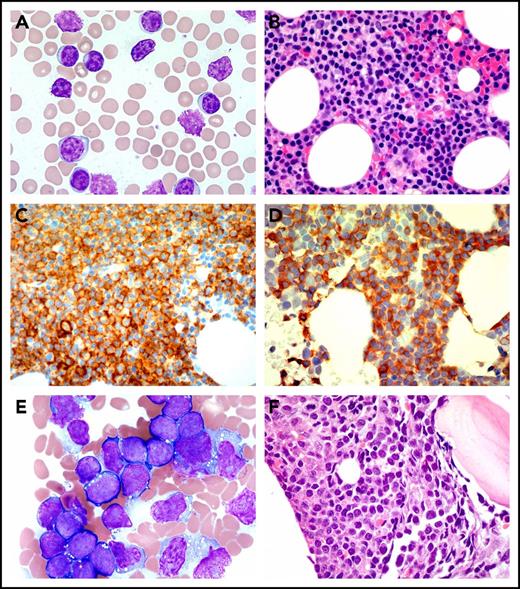 Figure 1. Peripheral blood and BM biopsy. (A) Peripheral blood smear (Wright stain, ×1000) and (B) BM core biopsy (Wright Giemsa, ×600) at the time of diagnosis of CLL. The neoplastic mature B-cells are small in size with clumped chromatin. (C) CD20 (immunoperoxidase, ×600) and (D) CD5 (immunoperoxidase, ×600) highlight the CLL cells. (E) BM aspirate (Wright Giemsa, ×1000) and (F) BM core biopsy (hematoxylin and eosin stain, ×600) at ALL diagnosis. The lymphoblasts are medium to large in size with fine chromatin, inconspicuous nucleoli, and scant basophilic cytoplasm with or without containing cytoplasmic vacuoles.