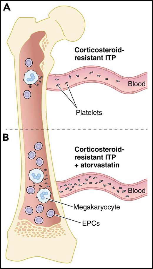 Atorvastatin increases EPCs and thrombopoiesis in corticosteroid-resistant ITP. (A) In the BM of corticosteroid-resistant ITP, decreased numbers and dysfunctional EPCs lead to platelet underproduction. (B) Upon treatment of corticosteroid-resistant ITP with atorvastatin, the number and function of EPCs are improved by downregulating the p38 MAPK pathway and upregulating the Akt pathway, leading to maturation of megakaryocytes and increased platelet production. Professional illustration by Patrick Lane, ScEYEnce Studios.