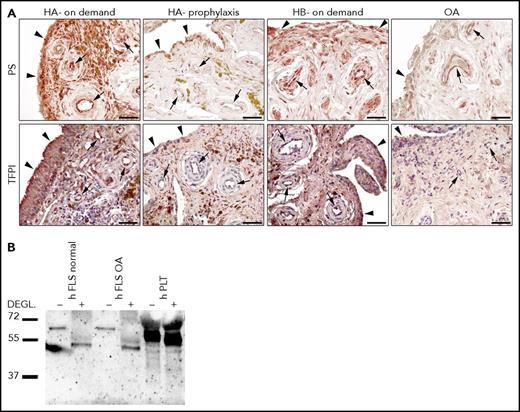 Figure 6. PS and TFPI in human synovium. (A) PS and TFPI are expressed in synovial tissue of patients with HA (on demand and on prophylaxis), HB on demand or osteoarthritis (OA). Arrowheads point to synovial lining layer and arrows to vascular structures in the sublining layer, all positive for both PS and TFPI. Scale bars: 50 µm. (B) Western blot analysis of conditioned media of primary human FLS cultures from a healthy individual and an OA patient before and after deglycosylation using anti-TFPI antibody. Human platelet lysate was used as a positive control for TFPIα. Blots are representative of 3 independent experiments. DEGL., deglycosylation; hFLS, human FLS; hPLT, human platelet lysate; OA, osteoarthritis.