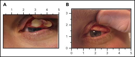 Figure 3. LC before and after replacement therapy with plasminogen (human). (A) Left eye lesion for patient 2 at day 0, prior to administration of plasminogen (human). The subject received plasminogen (human) at an IV dose of 6.6 mg/kg every second day. (B) Complete resolution of the left eye lesion after 4 weeks of treatment with plasminogen (human).