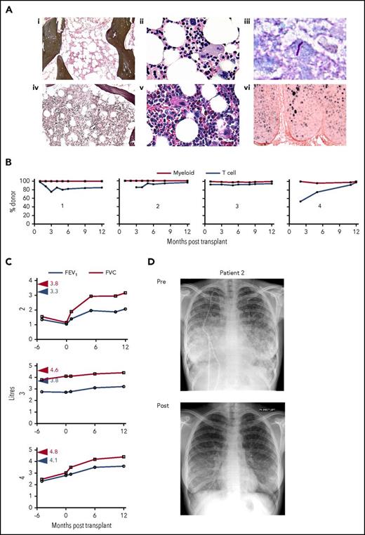 Figure 1. Bone marrow morphology, infection, posttransplantation chimerism, and recovery of respiratory function. (Ai-iii) represent patient 1; (iv-vi) represent patient 2. (i,iv) depict Gomori reticulin stain, (ii,v) depict megakaryocyte morphology by hematoxylin and eosin staining, (iii) depicts acid-fast bacilli in a skin biopsy of patient 1, and (vi) depicts HPV-16/18 RNA by in situ hybridization in a cervical biopsy of patient 2. (B) Percentage donor myeloid and T-cell chimerism in each patient as indicated by time after transplantation. (C) Recovery of lung volume after transplantation in patients 2 to 4. Red and blue arrowheads indicate predicted lung volume for patient height and weight. (D) Chest radiographs of patient 2 before (pre) transplantation with bilateral central symmetrical lung opacities, relative sparing of the apices and costophrenic angles, and extensive diffuse and miliary opacities, which had significantly resolved 6 months after (post) transplantation. FEV, forced expiratory volume; FVC, forced vital capacity.