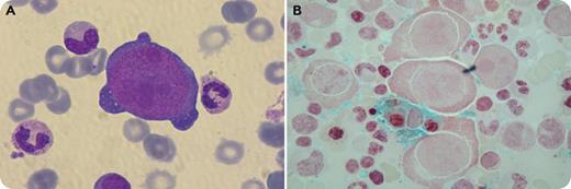 A 10-year-old, previously healthy girl presented with asthenia and fever of 3 days’ duration. Initial investigations revealed mild leukopenia and severe hemolytic anemia (hemoglobin = 4.9 mg/dL) with a markedly positive direct Coombs test. However, the absolute reticulocyte count was unexpectedly low, necessitating a bone marrow aspiration. It revealed marked hypoplasia of erythroid lineage that was mainly represented by scattered giant proerythroblasts showing intranuclear inclusions highly suggestive of underlying parvovirus B19 infection (panel A; May-Grunwald Giemsa stain, original magnification ×1000). Activated macrophages showing hemophagocytosis were also noted as highlighted on the iron stain preparation (panel B; Perls' Prussian blue stain, original magnification ×1000). After common causes of infection and hemolysis were ruled out, the diagnosis was confirmed by serology showing significantly increased anti–human parvovirus B19 immunoglobulin M and by qualitative polymerase chain reaction performed on a bone marrow sample. Therefore, the patient was diagnosed with autoimmune hemolytic anemia (AIHA) associated with pure red cell aplasia (PRCA) caused by parvovirus B19 infection. She was treated with steroids and intravenous immunoglobulin and had a complete recovery. / PRCA induced by parvovirus infection is a well-known entity. However, concomitant occurrence of AIHA has been rarely reported in such a context. This association should be considered when a patient presents with a severe acute anemia in the absence of a known cause of shortened erythrocyte lifetime.
