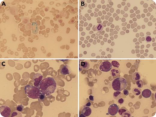 An 81-year-old man nourished exclusively by percutaneous endoscopic gastrostomy (PEG) due to complications following surgery was referred for macrocytic anemia and cutaneous hypersensitivity. The laboratory results were as follows: hemoglobin level 8.6 g/dL, mean corpuscular volume (MCV) 99 μL, reticulocytes 2.65%, platelet count 160 × 109/L, white blood cell count 4.5 × 109/L. Serum levels of vitamin B12, red blood cell folate, and thyrotropin were normal. The erythropoietin level was 65 U/L, and the ferritin level was 1189 ng/mL. The peripheral blood showed hyposegmented, hypogranular neutrophils (panel B; original magnification ×600, May-Grünwald-Giemsa stain). Bone marrow aspirate showed dyserythropoiesis, cytoplasmic vacuoles within erythroid and myeloid precursors (panels C-D; original magnification ×600, May-Grünwald-Giemsa stain), and increased plasma cells, some with irregular cytoplasmic contours. Perls staining showed iron in the plasma cells (panel A; original magnification ×600). Flow cytometry and cytogenetics were normal. These findings suggested copper deficiency, confirmed by a serum level of <3 μL/dL (reference range, 70-140 μL/dL) and a low 24-hour urine level. Zinc levels were normal. / After 2 months of copper supplementation via PEG, the hemoglobin level improved to 11 g/dL with an MCV of 89 fL and a serum copper level of 68 μL/dL. Neurologic symptoms improved. Copper deficiency may cause cytopenias and dysplasia, leading to misdiagnosis as myelodysplastic syndrome due to dyserythropoiesis, dysmyelopoiesis, and ringed sideroblasts. The presence of intracytoplasmic vacuoles in erythroid and myeloid precursors and of iron-containing plasma cells should prompt evaluation for copper deficiency.