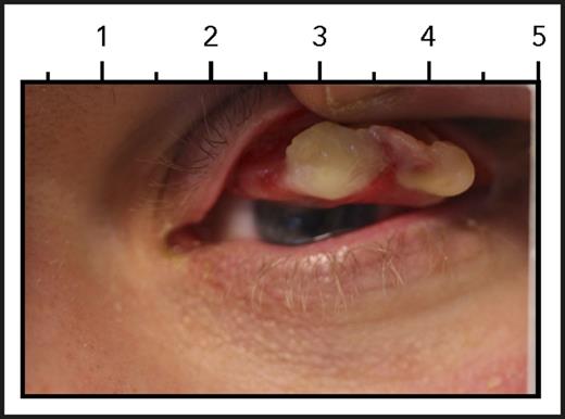 Ligneous conjunctiva. See Figure 3A in the article by Shapiro et al that begins on page 1301.