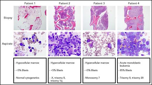 The spectrum of bone marrow findings in patients with GATA2 deficiency seen at the National Institutes of Health, ranging from a hypocellular marrow with normal cytogenetics to hypercellular marrow with unfavorable cytogenetics to overt AML with 85% monoblasts.