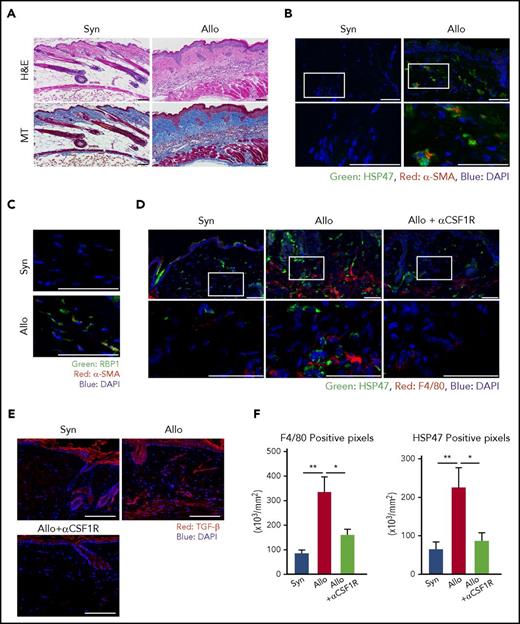 Figure 1. HSP47+ myofibroblasts are accumulated in the fibrotic skin lesion of chronic GVHD. BALB/c mice were transplanted with 8 × 106 BM cells plus 2.5 × 107 splenocytes from allogeneic B10.D2 or syngeneic BALB/c donors on day 0, following 6 Gy of TBI. Skin samples were harvested on day +42 after BMT for histological analyses. (A) H&E and MT images. (B) Immunofluorescent images for HSP47 (green) and α-SMA (red) with DAPI (blue) counterstaining. The area in the white rectangles is magnified and is shown below the original images. (C) Immunofluorescent images for RBP1 (green) and α-SMA (red) with DAPI (blue) counterstaining. (D-F) A group of mice were intraperitoneally injected with 0.5 mg/body of αCSF1R 3 times per week after BMT, and skin samples were harvested on day +42. (D) Immunofluorescent images for HSP47 (green) and F4/80 (red) with DAPI (blue) counterstaining. The area in the white rectangles is magnified and is shown below the original images. (E) Immunofluorescent images for TGF-β (red) with DAPI (blue) counterstaining. (F) Positive pixels of F4/80 (left) and HSP47 (right) on skin samples from allogeneic and syngeneic controls and αCSF1R-treated allogeneic mice (n = 7-10/group). Data from 2 independent experiments were combined and are shown as means ± standard error of the mean (SEM). Magnification, ×20. Scale bar, 50 μm. *P < .05; **P < .01. Allo, allogeneic; Syn, syngeneic.