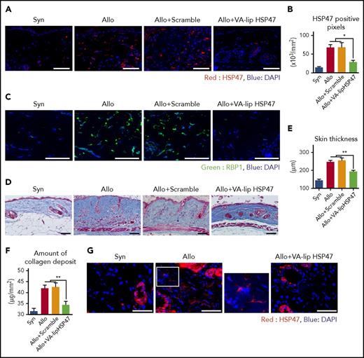 VA-lip HSP47 ameliorate fibrosis of the skin and salivary glands in chronic GVHD. (A-F) Mice were transplanted as in Figure 1. A group of allogeneic recipients were treated with VA-lip HSP47 or VA-lip containing scramble siRNA at 3 times per week from day +2 to day +41, and skin samples were harvested on day +42 after BMT. (A) Immunofluorescent images for HSP47 (red) with DAPI (blue) counterstaining. Magnification, ×40. Scale bar, 50 µm. (B) Numbers of positive pixels for HSP47 in syngeneic (n = 9), allogeneic controls (n = 13), and allogeneic recipients treated with VA-lip containing scramble siRNA (n = 12) or VA-lip HSP47 (n = 13) from 2 of 3 independent experiments were combined and shown as means ± SEM. (C) Immunofluorescent images for RBP1 (green) with DAPI (blue) counterstaining. Magnification, ×40. Scale bar, 50 µm. (D) Representative images of MT staining. Magnification, ×20. Scale bar, 50 µm. Skin thickness (E) and amount of collagen deposit (F) in syngeneic (n = 19), allogeneic controls (n = 28), and allogeneic recipients treated with VA-lip containing scramble siRNA (n = 15) or VA-lip HSP47 (n = 21) from 5 independent experiments were combined and shown as means ± SEM. (G-H) Submandibular glands were harvested on day +42 after BMT. (G) Immunofluorescent images for HSP47 (red) with DAPI (blue) counterstaining. Magnification, ×40. Scale bar, 50 µm. The area in the white rectangle is magnified and is shown on the right side of the original image. (H) Representative images of MT staining. Magnification, ×20. Scale bar, 50 µm. (I-M) Lethally irradiated B6 mice were transplanted with G-CSF–mobilized splenocytes from B6 (Syn, n = 10) or BALB/c (Allo, n = 21) donors. Allogeneic recipients were treated with VA-lip HSP47 (n = 7) or diluent (n = 14) at 3 times per week from day +2 to day +41, and skin samples were harvested on day +42 after BMT. (I) Immunofluorescent images for HSP47 (red) with DAPI (blue) counterstaining. Magnification, ×40. Scale bar, 50 µm. (J) Numbers of positive pixels for HSP47 in syngeneic, allogeneic controls, and allogeneic recipients treated with VA-lip HSP47. (K) Representative images of MT staining. Magnification, ×20. Scale bar, 50 µm. Skin thickness (L) and amount of collagen deposit (M) in syngeneic, allogeneic controls, and allogeneic recipients treated with VA-lip HSP47. Data from 2 independent experiments were combined and are shown as means ± SEM. *P < .05; **P < .01.