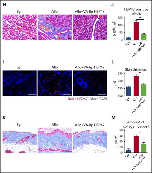 VA-lip HSP47 ameliorate fibrosis of the skin and salivary glands in chronic GVHD. (A-F) Mice were transplanted as in Figure 1. A group of allogeneic recipients were treated with VA-lip HSP47 or VA-lip containing scramble siRNA at 3 times per week from day +2 to day +41, and skin samples were harvested on day +42 after BMT. (A) Immunofluorescent images for HSP47 (red) with DAPI (blue) counterstaining. Magnification, ×40. Scale bar, 50 µm. (B) Numbers of positive pixels for HSP47 in syngeneic (n = 9), allogeneic controls (n = 13), and allogeneic recipients treated with VA-lip containing scramble siRNA (n = 12) or VA-lip HSP47 (n = 13) from 2 of 3 independent experiments were combined and shown as means ± SEM. (C) Immunofluorescent images for RBP1 (green) with DAPI (blue) counterstaining. Magnification, ×40. Scale bar, 50 µm. (D) Representative images of MT staining. Magnification, ×20. Scale bar, 50 µm. Skin thickness (E) and amount of collagen deposit (F) in syngeneic (n = 19), allogeneic controls (n = 28), and allogeneic recipients treated with VA-lip containing scramble siRNA (n = 15) or VA-lip HSP47 (n = 21) from 5 independent experiments were combined and shown as means ± SEM. (G-H) Submandibular glands were harvested on day +42 after BMT. (G) Immunofluorescent images for HSP47 (red) with DAPI (blue) counterstaining. Magnification, ×40. Scale bar, 50 µm. The area in the white rectangle is magnified and is shown on the right side of the original image. (H) Representative images of MT staining. Magnification, ×20. Scale bar, 50 µm. (I-M) Lethally irradiated B6 mice were transplanted with G-CSF–mobilized splenocytes from B6 (Syn, n = 10) or BALB/c (Allo, n = 21) donors. Allogeneic recipients were treated with VA-lip HSP47 (n = 7) or diluent (n = 14) at 3 times per week from day +2 to day +41, and skin samples were harvested on day +42 after BMT. (I) Immunofluorescent images for HSP47 (red) with DAPI (blue) counterstaining. Magnification, ×40. Scale bar, 50 µm. (J) Numbers of positive pixels for HSP47 in syngeneic, allogeneic controls, and allogeneic recipients treated with VA-lip HSP47. (K) Representative images of MT staining. Magnification, ×20. Scale bar, 50 µm. Skin thickness (L) and amount of collagen deposit (M) in syngeneic, allogeneic controls, and allogeneic recipients treated with VA-lip HSP47. Data from 2 independent experiments were combined and are shown as means ± SEM. *P < .05; **P < .01.