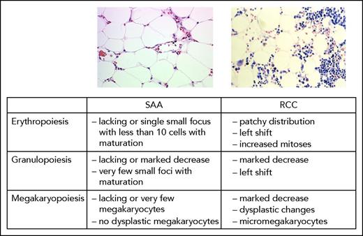 Figure 1. Histopathologic features and criteria differentiating RCC from SAA.