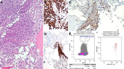 A 57-year-old man underwent bone marrow examination to investigate lumbar compression fractures and an elevated λ light chain level of 3508 mg/L. The marrow aspirate demonstrated 50% abnormal plasma cells diagnostic of myeloma. The trephine biopsy revealed an extensive infiltrate of plasma cells, as well as a paratrabecular aggregate of spindle-shaped cells (panel A; hematoxylin and eosin stain, original magnification ×400). These latter cells were not positive for CD138 (panel B; original magnification ×400) but stained positive for both mast cell tryptase (panel C; original magnification ×400) and CD117 (panel D; original magnification ×400). Immunophenotyping confirmed these as aberrant (using CD117 vs side scatter gating strategy) with expression of CD2 and CD25 (panel E). The combination of the histologic appearance (major criterion) and antigenic aberrancy (minor criterion) fulfilled the diagnostic criteria of systemic mastocytosis. Apart from back pain attributable to the compression fractures, there were no other symptoms of mastocytosis present. A CKIT D816V mutation (variant allele fraction <0.1%) was detected; however, serum tryptase level was not elevated. / “Systemic mastocytosis with an associated hematologic neoplasm” (2016 World Health Organization update) is most frequently found with myeloid malignancies. Myeloma has rarely been described as an association in this category. Initially, the spindle-shaped cell aggregate of mast cells was thought to be part of the plasma cell infiltrate, demonstrating the importance of confirmatory immunohistochemistry and immunophenotyping in resolving cases with atypical morphology.