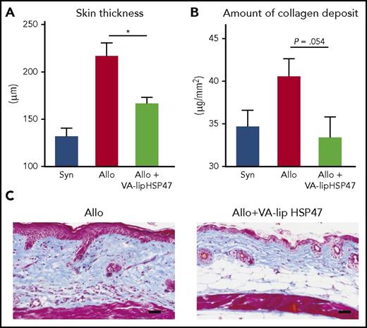 VA-lip HSP47 resolves established skin fibrosis in chronic GVHD. Skin sickness in allogeneic recipients as compared with allogeneic recipients treated with VA-lip HSP47 (A). This reduced sickness is related due to reduced amount of collagen deposit in the skin of treated mice (B). This direct effect of VA-lip HSP47 on collagen deposit is illustrated by the 2 skin biopsies (C) of nontreated and VA-lip HSP47-treated recipients. Allo, allogeneic; Syn, syngeneic; VA-lip HSP47, vitamin A–coupled liposomes carrying HSP47 siRNA. The figure has been adapted from Figure 4 in the article by Yamakawa et al that begins on page 1476.