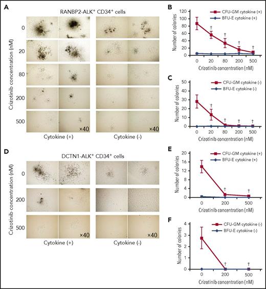 Figure 3. Effect of crizotinib on colony formation by JMML cells with ALK/ROS1 fusion. (A-C) Effect of crizotinib (ALK/ROS1/MET inhibitor) on colony formation by RANBP2-ALK+ CD34+ cells. A total of 1 × 103 CD34+ cells from a patient with RANBP2-ALK was cultured for 2 weeks with or without cytokine-supplemented culture media in the presence or absence of the indicated amount of crizotinib. (A) Microscopic appearance of colony-forming unit, granulocyte-macrophage (CFU-GM) colonies. (B-C) Numbers of colonies (B) with and (C) without cytokines. (D-F) Effect of crizotinib on colony formation by DCTN1-ALK+ CD34+ cells. (D) Microscopic appearance of CFU-GM colonies. (E-F) Numbers of colonies (E) with and (F) without cytokines. BFU-E, burst-forming unit erythroid. †P < .01.