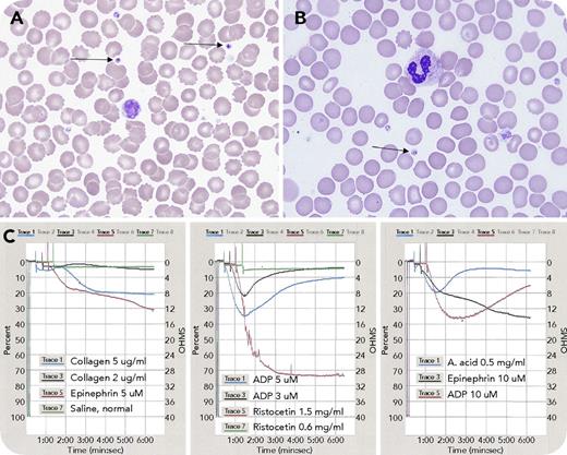 A 3-year-old boy presented with a medical history of facial malformation, single kidney, hypoplastic left ventricle, and complex deletion of chromosome 11 at q24.2q25, consistent with Jacobsen syndrome. He had an International Society on Thrombosis and Haemostasis bleeding assessment tool score of zero, but was thrombocytopenic at birth, with gradual normalization. Laboratory findings were: white blood cell count, 6.8 × 109/L; red blood cell count, 6.45 × 1012/L; hemoglobin, 16.2 g/dL; hematocrit, 48.8%; mean corpuscular volume, 75.7 fL; platelets, 115 × 109/L; prothrombin time, 12.6 seconds; international normalized ratio, 0.93; and activated partial thromboplastin time, 26.2 seconds. Peripheral blood smear showed variation in platelet morphology, with occasional giant forms and large granules, including large solitary inclusions in 8% of platelets (panels A-B, arrows; original magnification ×1000; Wright-Giemsa stain), consistent with α-granule fusion. Light transmission platelet aggregometry revealed abnormal responses to adenosine 5′-diphosphate and arachidonic acid: initial aggregation followed by complete disaggregation; epinephrine: biphasic pattern with delayed and reduced maximum aggregation; and collagen: no aggregation (panel C). / Differential diagnosis for macrothrombocytopenia is broad. Considering the patient’s known Jacobsen syndrome, the qualitative platelet defects are consistent with Paris-Trousseau thrombocytopenia as a result of mutations in FLI1 transcription factor gene involved in megakaryopoiesis. The platelet aggregometry findings suggest a dense granule storage pool deficiency. Supplementary investigations will be necessary to identify whether the granule defects are causative of the platelet dysfunction. Lifestyle modifications and avoidance of platelet-impairing medications are recommended because of potential increased bleeding risk.
