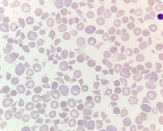 A presumably healthy full-term boy developed icterus shortly after birth. He was irritable and had ecchymoses on his heels and low oxygen saturation (85%). Venous blood gas analysis showed acidosis (pH 7.16) and elevated lactate (5.1 mmol/L). Sepsis or congenital heart failure was suspected. Echocardiography was normal. Blood tests taken 28 hours after birth showed hemoglobin 135 g/L, white cell count 30 × 109/L, platelet count 6 × 109/L, and negative direct antiglobulin test. A peripheral blood smear revealed pronounced anisopoikilocytosis with 28% schistocytes and confirmed thrombocytopenia (May-Grünwald Giemsa stain; original magnification ×100). This was reported to the pediatrician, who immediately prescribed red blood cells and platelets. However, the patient’s condition deteriorated. Bilirubin was highly elevated (32.8 mg/dL). Treatment with immunoglobulins and phototherapy was initiated, but he died 34 hours after birth. Autopsy was inconclusive. / Postmortem, on the basis of laboratory findings and blood smear examination, the clinical pathologist suggested the possibility of hereditary thrombotic thrombocytopenic purpura (TTP). Genetic tests confirmed biallelic ADAMTS13 gene mutations. Hereditary TTP caused by ADAMTS13 mutations is a rare but serious condition, often presenting during the newborn period with thrombocytopenia and microangiopathic hemolytic anemia. It is vital that health professionals recognize TTP in newborns to avoid fatal outcomes as in this case.