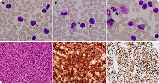 A 47-year-old man was admitted with a 2-week history of fever, asthenia, and dyspnea. A full blood count showed a white blood cell count of 11.5 × 109/L (78.8 × 109/L after 1 week). Blood smears showed 44% tumor cells with loose chromatin and indented, convoluted, folded nuclei, some with obvious indentation (panels A-B, black arrows; Wright-Giemsa stain, original magnification ×100). The cytoplasm was small and gray blue (panels A-B). A bone marrow aspirate identified 20% such cells (panel C; Wright-Giemsa stain, original magnification ×100). Flow cytometry suggested T-cell lymphocytosis (positivity for CD4 and CD2 and negativity for CD3, CD16, CD8, CD56, CD57, and B-cell phenotype). Immunocytochemistry for these lymphocytes (bone marrow biopsy) was positive for CD3, CD5, CD30, CD45RO, and CD43. Node biopsy showed infiltration by the same small lymphocytes (panel D; hematoxylin and eosin stain, original magnification ×20) with immunocytochemistry positive for CD30 (panel E; immunoperoxidase stain, original magnification ×20), anaplastic lymphoma kinase (ALK) (panel F; immunoperoxidase stain, original magnification ×10), CD5, and, partially, CD3 (Ki67 index, 60%). A T-cell receptor gene rearrangement test was positive. A diagnosis of the small cell variant of anaplastic large cell lymphoma (ALCL) presenting in the leukemic phase was made. The patient received brentuximab vedotin and chemotherapy with clinical improvement. / ALCLs feature with high variability in clinical presentation. A small cell variant ALCL should be considered as a differential diagnosis for unusual T-cell lymphocytosis.
