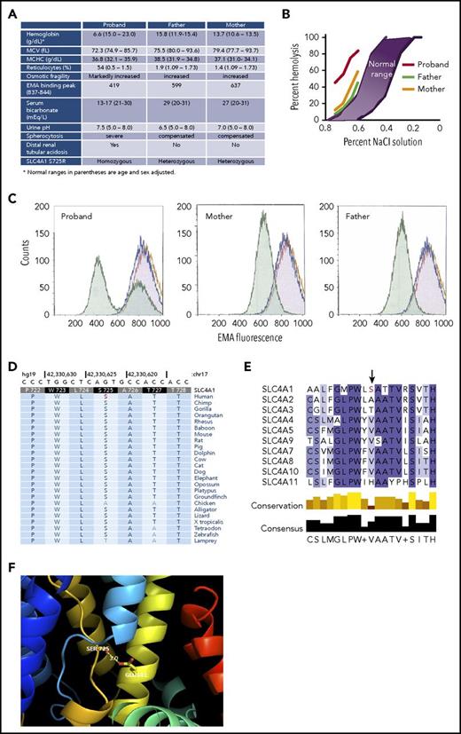Figure 1. Hereditary spherocytosis due to a mutation in Band 3. (A) Clinical and laboratory data. (B) Incubated osmotic fragility. (C) EMA binding. Normal control cells (purple); stain control (gold); proband and parents’ cells (green). The 2 green peaks in the proband panel represent transfused cells (higher EMA fluorescence) and patient’s endogenous cells (lower EMA fluorescence). (D) Sequence conservation of Ser725 in SLC4A1 across vertebrate species, including the clades of placental mammals and the extant Eutherians. (E) Lack of sequence conservation of Ser725 in SLC4 transporters. There is no serine at position 725 in any of the other 9 SLC4 transporters. (F) Structure of SLC4A1 showing the location of Ser725 in the substrate-binding site of Band 3 between the N-termini of TM3 (light blue) and TM10 (gold). The side chain of Ser725 is only 3 Å away from Glu681, the proton-binding site located on TM8 (yellow). Mutation of serine to arginine at 725 is predicted to form a salt-bridge with Glu681, blocking anion transport. MCHC, mean corpuscular hemoglobin concentration; MCV, mean corpuscular volume.