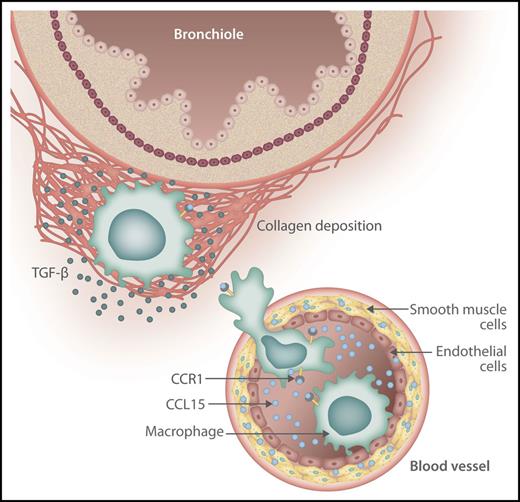 Hypothetical model of CCL15 role in chronic lung GVHD. Vascular smooth muscle cells release CCL15 into the blood vessel lumen, where it binds to CCR1 on macrophages. The macrophages then infiltrate the lung tissue where they release TGF-β and induce collagen deposition around the bronchioles. TGF, transforming growth factor. Professional illustration by Somersault18:24.