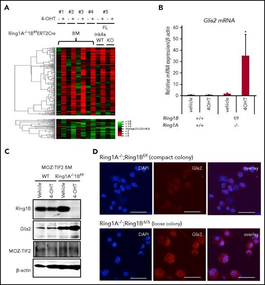 Figure 3. Derepression of Glis2 expression in Ring1A/B-deleted MOZ-TIF2 leukemic cells. (A) Hierarchical clustering analysis of gene expression in MOZ-TIF2 leukemic cells from Ring1A−/−;Ring1Bf/f BM, Ring1A−/−;Ring1BΔ/Δ BM, Ring1A−/−;Ring1Bf/f Ink4a/Arf+/+ FL, Ring1A−/−;Ring1BΔ/Δ;Ink4a/Arf+/+ FL, Ring1A−/−;Ring1Bf/f;Ink4a/Arf−/− FL, and Ring1A−/−;Ring1BΔ/Δ;Ink4a/Arf−/− FL. 1, 2, 4, and 5 refer to results obtained from cells cultured for 48 hours in the presence or absence of 4-OHT; 3 refers to results obtained from cells cultured for 7 days. (B) Quantitative RT-PCR analysis of Glis2 expression. RNA was extracted from cells incubated with 4-OHT for 48 hours (mean ± SD, *P < .05, n = 3). (C) Western blot analysis of Ring1B, Glis2, and MOZ-TIF2 expression. Cell lysates were obtained after incubation with 4-OHT for 48 hours. (D) Immunofluorescence staining for Glis2 in MOZ-TIF2 leukemic cells incubated with 4-OHT for 96 hours. Cells were picked from vehicle-treated compact colonies or 4-OHT–treated loose colonies and attached to glass slides by cytospin. Scale bar, 50 μm. FL, fetal liver.