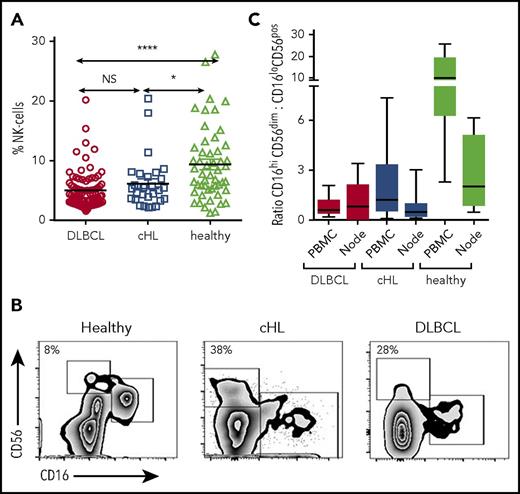 Figure 1. Circulating and intratumoral NK-cell subsets in patients with cHL and DLBCL and in the blood of healthy participants. (A) Pretherapy circulating CD3−CD56+ NK cells in patients with cHL and DLBCL and healthy participants. (B) Representative fluorescence-activated cell sorter plots of CD3−CD56dimCD16+ and CD3−CD56hiCD16-ve subsets of circulating NK cells in healthy participants and patients with cHL and DLBCL. Percentage of CD3−CD56hiCD16-ve as a proportion of CD3−CD56+ NK cells is shown. (C) Ratios of CD3−CD56dimCD16+ and CD3−CD56hiCD16-ve subsets in circulating and intratumoral NK cells in patients with cHL and DLBCL, and from the circulation and nodes in healthy participants. Asterisks denote significance: *P < .05; **P < .01; ***P < .001; ****P < .0001. NS, not significant.