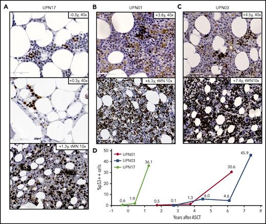 Figure 6. Visualization of clonal expansion of TP53-mutated cells. Immunohistochemical staining for p53 protein expression on BM biopsies at tMN diagnosis and preleukemic time points for patients UPN17 (A), UPN01 (B), and UPN03 (C). Time points of biopsy and magnification are indicated in the figure panels. (D) Percentage of cells showing high p53 protein expression (p53++ cells) were scored at different time points (pre- and post-ASCT) for the 3 patients depicted in panels A-C; last time point is moment of tMN diagnosis.