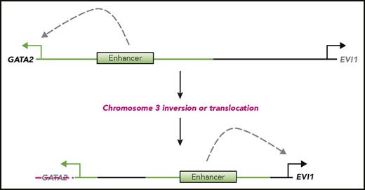 Figure 2. Inversion or translocation of chromosome 3 drives AML through enhancer dysregulation. An enhancer on chromosome 3 normally drives expression of the TF GATA2 in hematopoietic progenitor cells. Elsewhere on chromosome 3 is the TF EVI1. Structural abnormalities of chromosome 3 found in one type of AML, such as inv(3) or t(3;3), lead to the movement of this enhancer away from GATA2, resulting in loss of expression, and nearer to EVI1, driving its expression. A series of studies of these chromosome 3 abnormalities have determined that ectopic transcription of EVI1 is sufficient to drive AML, whereas concomitant loss of GATA2 expression accelerates this process.