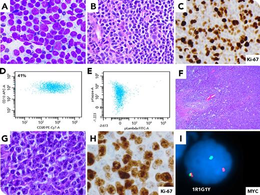 A 66-year-old man with follicular lymphoma after multiple therapies presented with a retroperitoneal mass (panel A: fine needle aspirate, Diff-Quik stain, 1000× oil immersion; panels B-C: needle biopsy, hematoxylin and eosin (H&E) and Ki-67 stains, 500× oil immersion) compatible with his history of follicular lymphoma. Limited biopsy precluded grading and Ki-67 staining was 40%. Flow cytometry showed a κ-restricted, CD10-positive mature B-cell population (panels D-E), and he was treated with chemoradiotherapy. Five years later, he presented with a testicular mass and orchiectomy showed germinal center type, Epstein-Barr virus–encoded small nuclear RNA in situ hybridization–negative, diffuse large B-cell lymphoma with “starry sky pattern” (panels F-G: H&E stain, 100× and 1000× oil immersion), focal necrosis, and lymphoma at the spermatic cord margin. Proliferation index was 60% to 70% (panel H: Ki-67 stain, 1000× oil immersion). Fluorescence in situ hybridization confirmed MYC rearrangement (panel I; 77% of nuclei examined), IGH/BCL2 (31% of nuclei examined), and IGH gain (19.5% of nuclei examined) but no BCL6 rearrangement. / The presence of large atypical cells in follicular lymphomas has been associated with early large cell transformation. T-cell–mediated immunosurveillance and chemotherapy are thought to have reduced efficacy in immune-privileged sites, where transformation to aggressive variants like blastoid or double-hit large B-cell lymphomas may be more likely.