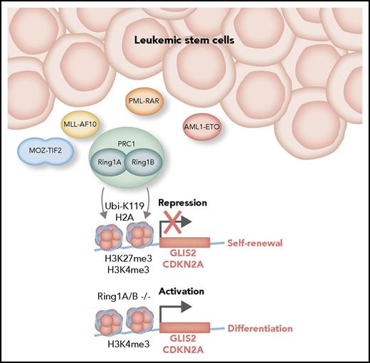 Schematic representation of the action of Ring1A and Ring1B proteins in promoting the maintenance of AML cells derived from MOZ-TIF2, MLL-AF10, PML-RAR, or AML1-ETO fusion proteins. Ring1 proteins associated with PRC1 complexes catalyze the ubiquitylation of lysine K119 of histone H2A (H2AK119-Ubi). This modification, in addition to the H3K27me3, contributes to repression of genes, including GLIS2 and CDKN2A, promoting the self-renewal of leukemia-initiating cells. Because these normally bivalent promoters also contain the activating chromatin modification H3K4me3, inactivation of Ring1 results in derepression of GLIS2, CDKN2A, and other genes, promoting differentiation.