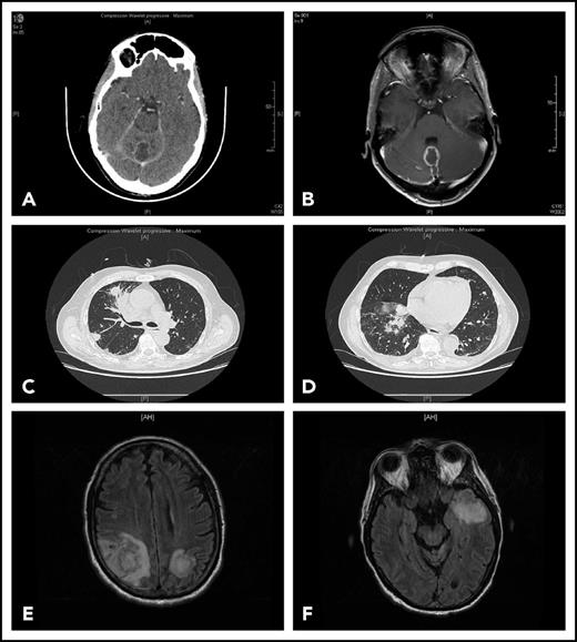 Figure 1. Representative findings in 2 patients with IFI. Patient 1 had been receiving ibrutinib 420 mg/d for 4 months for CLL associated with grade 3 autoimmune neutropenia when she complained of gait disorder. Computed tomography scan (A) and T1-weighted magnetic resonance imaging with gadolinium injection (B) revealed a solitary abscess of the vermis. Neurosurgical drainage disclosed Aspergillus fumigatus. Patient 2 was hospitalized after a third cycle of bendamustine, rituximab, ibrutinib for fever, cough, and confusion. Chest computed tomography scan revealed multiple pulmonary nodules (C-D) and T2-weighted fluid attenuation inversion recovery (FLAIR) magnetic resonance imaging multiple cerebral abscesses (E-F). Aspergillus antigenemia was strongly positive, and Aspergillus fumigatus was isolated in the bronchoalveolar lavage.