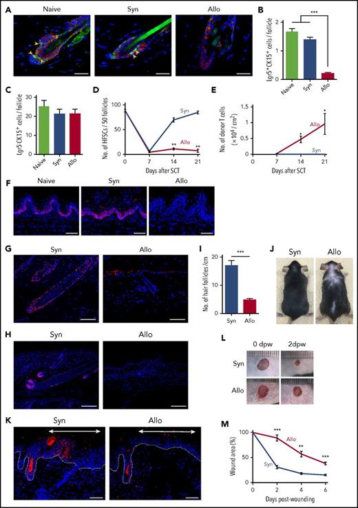 Figure 2. GVHD reduces tissue stem cells in the skin and lingual epithelium and impairs hair and skin regeneration. Lethally irradiated B6 or B6-Lgr5EGFP-cre/ER mice were transplanted as in Figure 1. Back skins from B6-Lgr5EGFP-cre/ER recipients were harvested on day +14 after SCT. (A) Representative immunofluorescent images of EGFP (green), CK15 (red), and DAPI (blue). Original magnification ×40. Scale bar, 25 μm. Numbers of Lgr5+CK15+ (B) and Lgr5−CK15+ (C) cells per hair follicle from 2 independent experiments (n = 6-8 per group). (D) The numbers of Lgr5+ HFSCs (n = 5-6 per group) and (E) infiltrating T cells in the back skin (n = 4-6 per group) on day +7, +14, +21 after SCT from 2 independent experiments. (F) Immunofluorescent staining of CK15 (red) and DAPI (blue) in lingual sections on day +7. Original magnification ×20. Scale bar, 50 μm. (G-H) Representative images of immunofluorescent staining with anti-SOX9 (G) or anti-Ki-67 (H) mAbs (red) with DAPI (blue) in the skin samples harvested on day +35 after SCT. Original magnification ×10. Scale bar, 100 μm. (I-J) Numbers of hair follicles from independent 2 experiments (I, n = 8-9 per group) and macroscopic images of recipient mice (J) on day +35 after SCT. (K-M) Full-thickness round skin was removed from the shaved back of B6-Lgr5EGFP-cre/ER × R26tdTomato mice after Cre recombination with tamoxifen treatment after SCT. (K) Representative immunofluorescent images of tdTomato (red), and DAPI (blue) 12 days after incision. The regenerated epithelium was marked with double-headed arrows and dot lines show epidermal-dermal junction. Original magnification ×20. Scale bar, 50 μm. Macroscopic images (L) and relative wound area (M) from 2 independent experiments were combined (n = 6 per group). The Mann-Whitney U test or 1-way ANOVA followed by the Tukey posttest was used to compare the data (**P < .01; ***P < .005). Data represent the mean ± SEM. dpw, days postwounding.